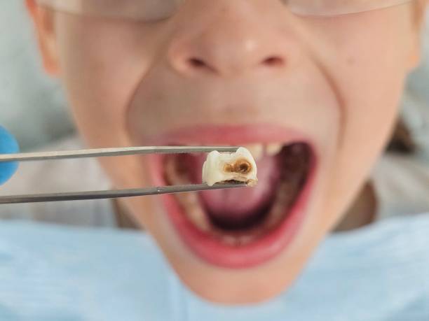 Best Emergency Pediatric Dentist  in Clarkston Heights Vineland, WA